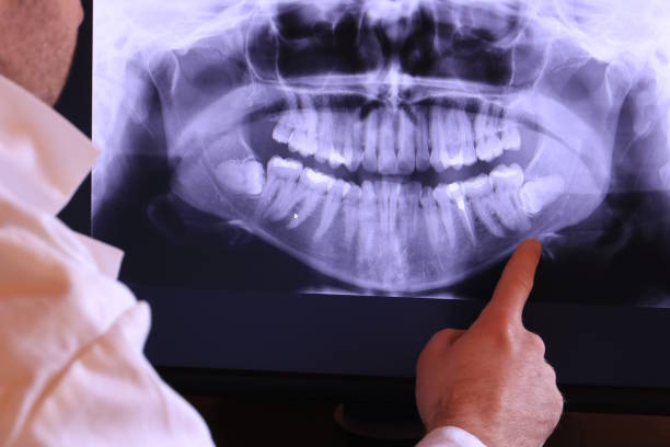 Best Emergency Wisdom Teeth Removal in Long Hill, CT