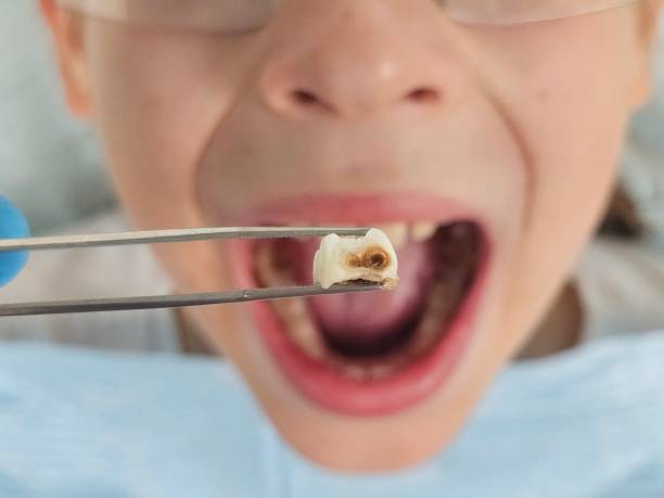 Best Emergency Treatment for Dental Infections or Abscesses in Long Hill, CT